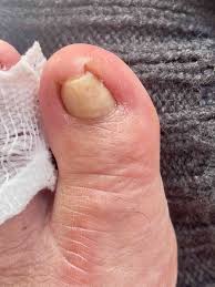 Twisted nail case study 2